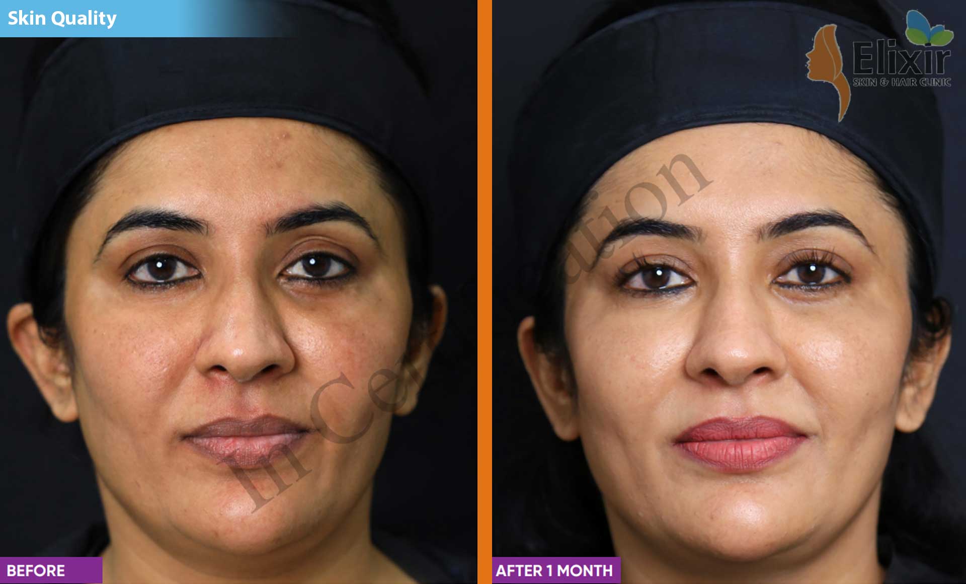 Elixir Anti Aging Dermal Fillers